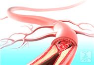 動脈斑塊的治療