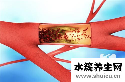 動脈斑塊的治療