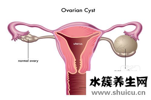 子宮肌瘤有什么癥狀