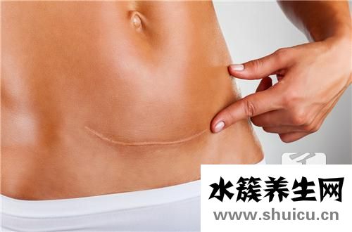 多囊卵巢怎么治療