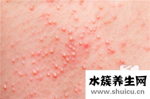 丘疹性蕁麻疹圖