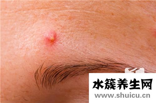 火癤子的快速治療方