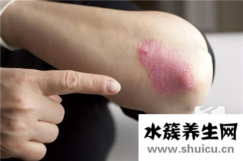 濕毒最佳治療方法