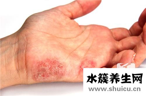 手背上起小疙瘩很癢