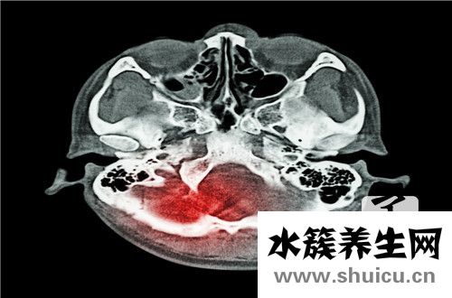 慢性硬膜下血腫