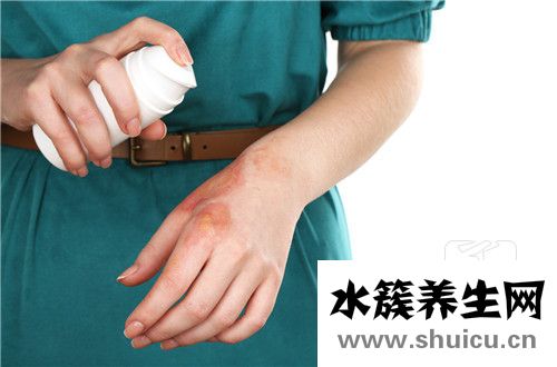 被燙傷起水泡怎么辦