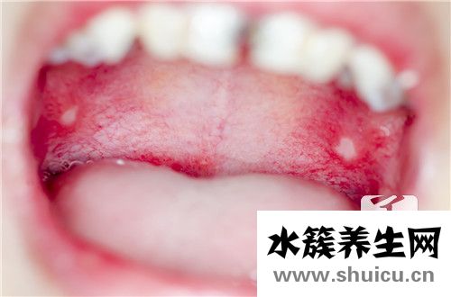 口腔潰瘍缺什么維生素