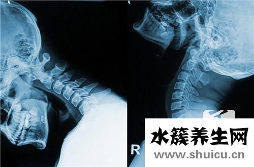 頸椎骨質增生怎么辦