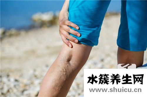 靜脈曲張是什么