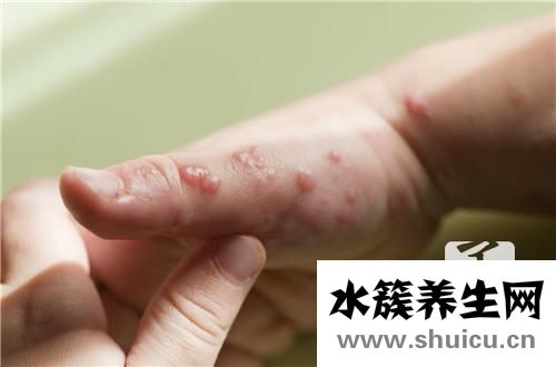 皮膚細(xì)菌感染