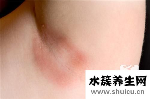 蕁麻疹是否會傳染