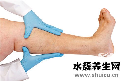 靜脈曲張襪有用嗎