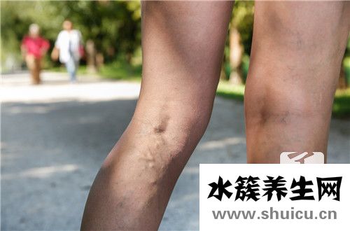 靜脈曲張襪有用嗎