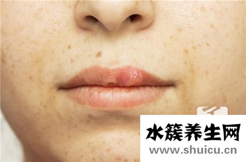 牛皮癬最新治療方法