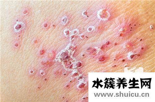 全身紅點不痛不癢