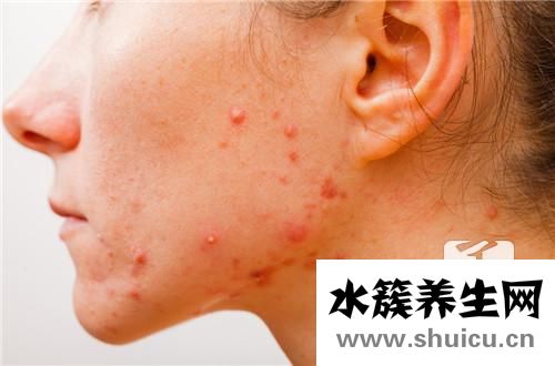 痤瘡中醫(yī)治療