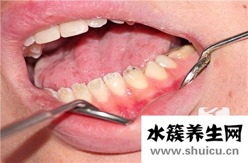 經期為什么不能拔牙