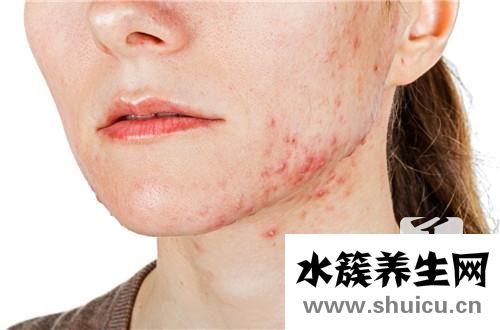 滿(mǎn)臉痘印怎么辦