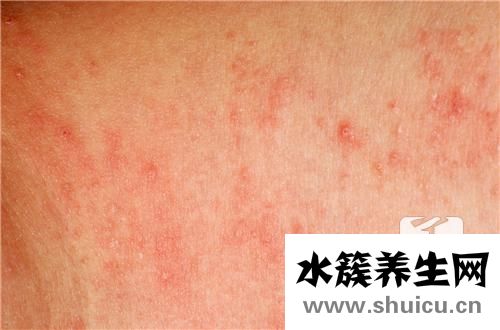 疥瘡怎么引起的