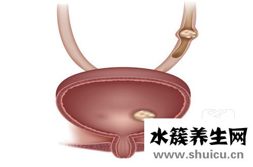 女性膀胱炎的癥狀