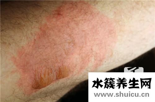 被螞蟻咬了怎么辦