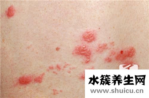 皰疹最佳治療方法