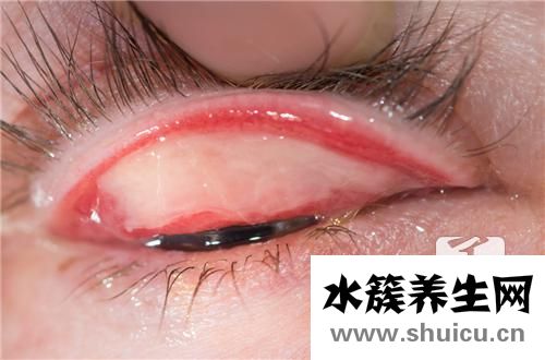 過敏性結膜炎癥狀