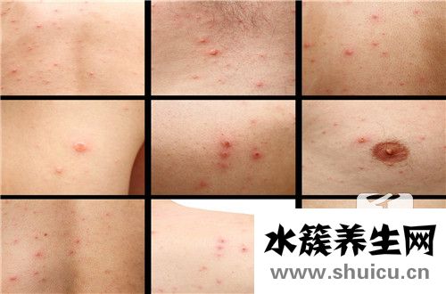 艾滋病皮疹圖片