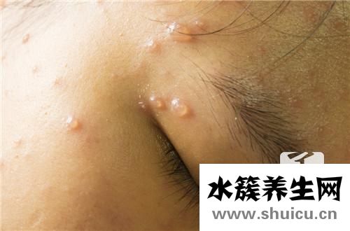 出水痘要注意什么