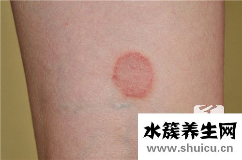 身上有小紅點是怎么回事