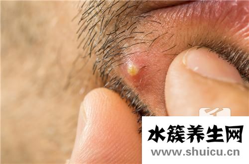 眼角內(nèi)長(zhǎng)了個(gè)小白膿點(diǎn)