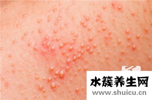 背上長了個硬疙瘩