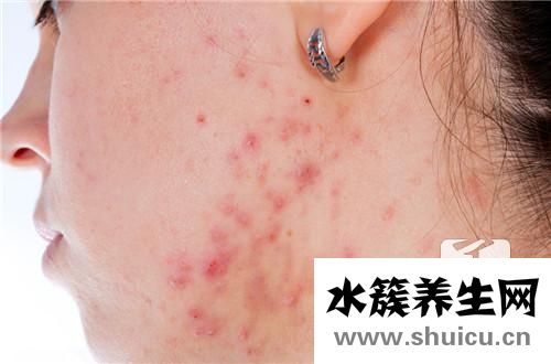 紅色痘印怎么消除最快