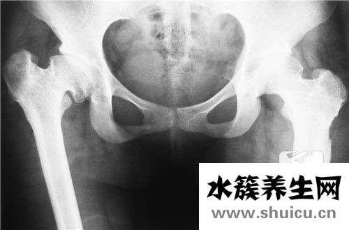 類風濕自愈的好辦法