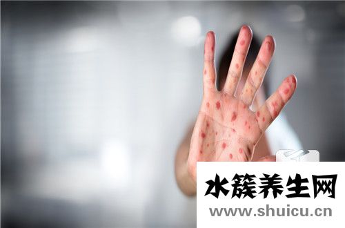 過敏性濕疹初期圖片