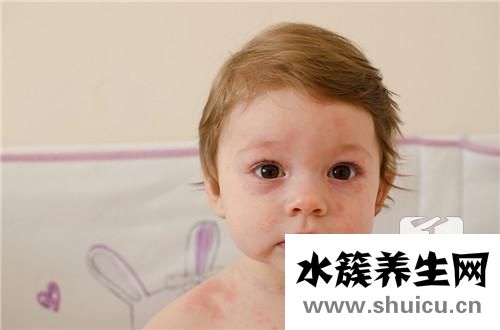幼兒急疹的癥狀及治療