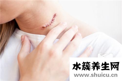 淋巴結節怎么消除