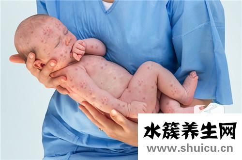 風疹塊治療方法