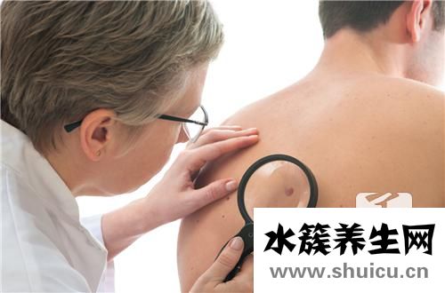 去黑痣最有效方法