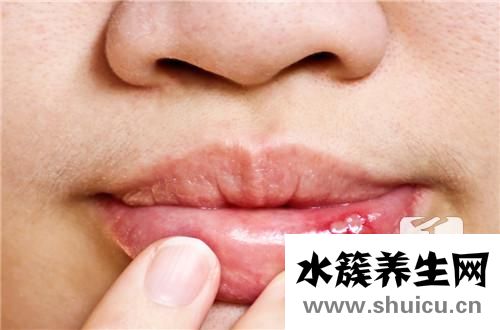 囗腔潰瘍吃什么好得快