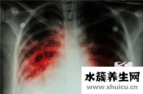 肺結(jié)核病人能活多久