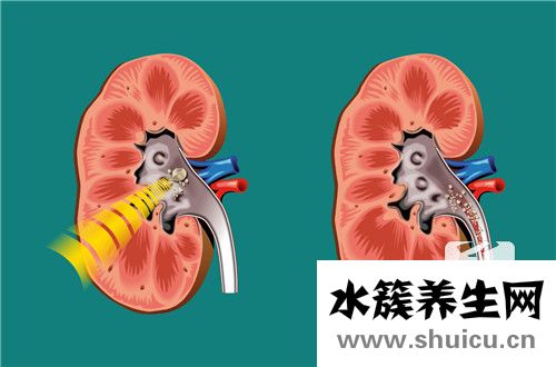 體外碎石后注意事項