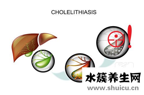 膽結(jié)石排出