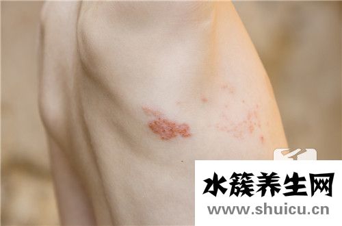 身上出硬疙瘩還癢同