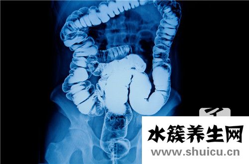 乙狀結(jié)腸炎