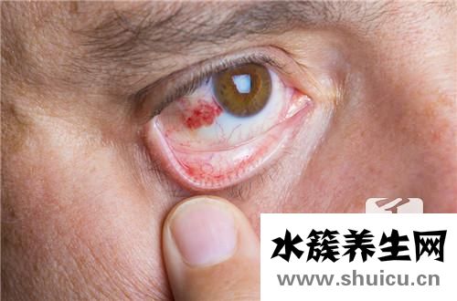 去紅血絲最有效