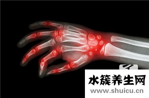 年輕人痛風能活幾十歲