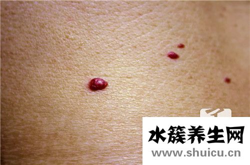 顱內海綿狀血管瘤