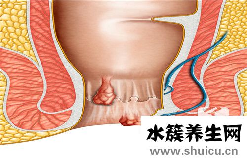 馬齒莧治療痔瘡