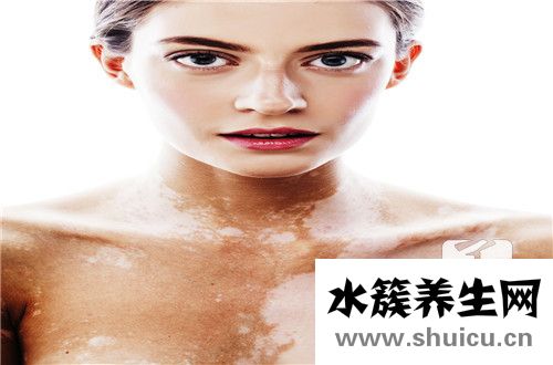 缺鋅臉上白斑同